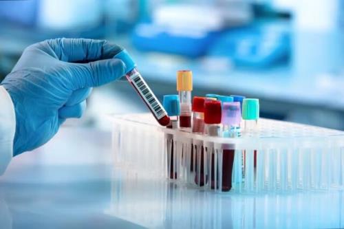 یک آزمایش خون جدید برای تشخیص پارکینسون در مراحل اولیه
